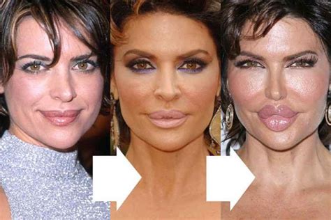 lisa rinna before and after lip surgery